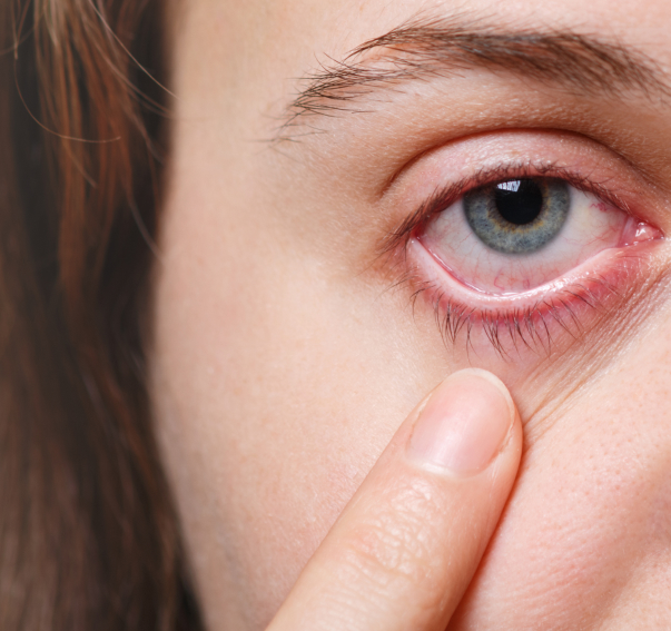 Dry Eye Disease