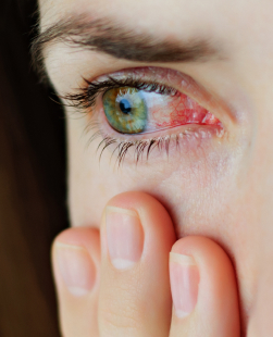 seyes are red or irritated